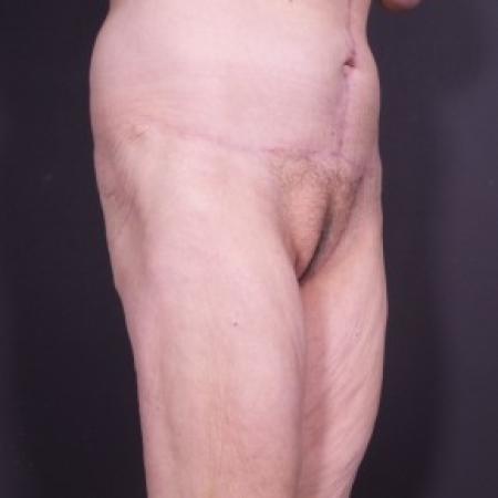 After image 2 Case #85281 - Fleur De Lis Abdominoplasty after Weight Loss