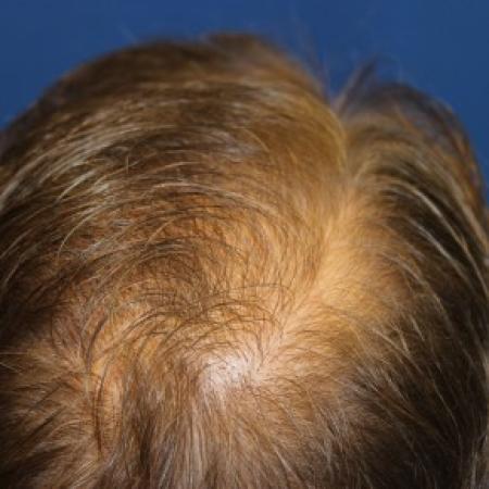 After Case #87391 - Hair Transplantation San Diego