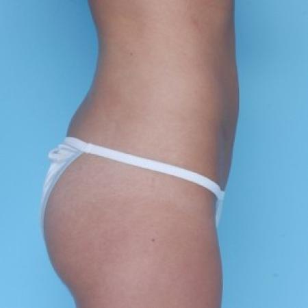 After image 2 Case #82291 - Liposuction