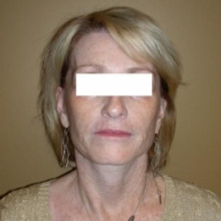 After image 1 Case #79801 - Sculptra