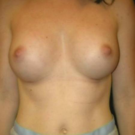 After image 1 Case #82891 - Breast Augmentation using Smooth Round Silicone Gel Implants