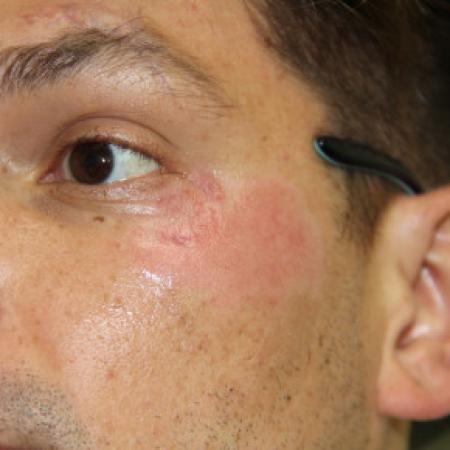 After image 1 Case #103371 - Road Rash Dermabrasion