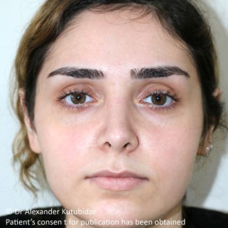 After image 1 Case #105221 - Primary Septorhinoplasty