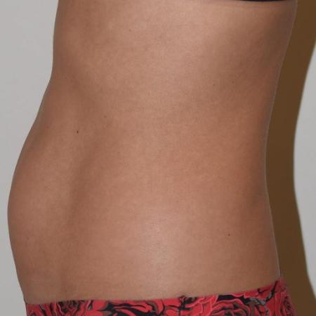 Before image 2 Case #105271 - Liposuction, Cellfina, BodyTite & Morpheus8