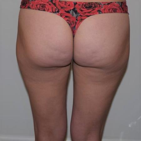 Before image 5 Case #105271 - Liposuction, Cellfina, BodyTite & Morpheus8