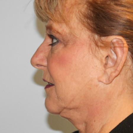 After image 2 Case #107716 - Otoplasty