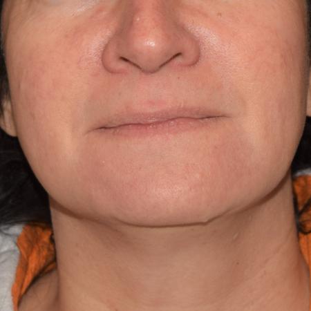 Before image 1 Case #107921 - Teoxane RHA Dermal Fillers