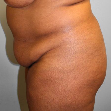 Before image 3 Case #108226 - Tummy Tuck & Lipo