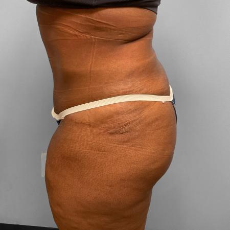 After image 3 Case #108226 - Tummy Tuck & Lipo