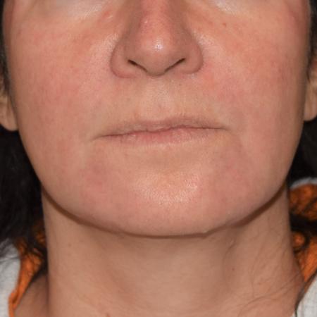 After image 1 Case #107921 - Teoxane RHA Dermal Fillers