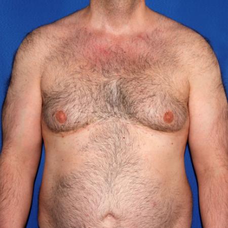 Before image 1 Case #108916 - Gynecomastia Correction