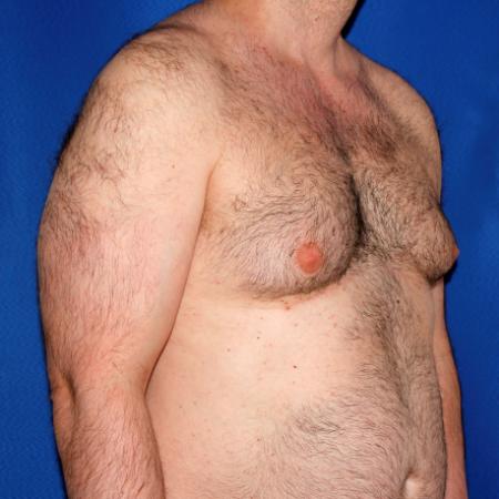 Before image 2 Case #108916 - Gynecomastia Correction