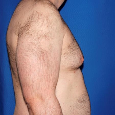 Before image 3 Case #108916 - Gynecomastia Correction