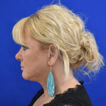 After image 3 Case #108766 - Face Lift