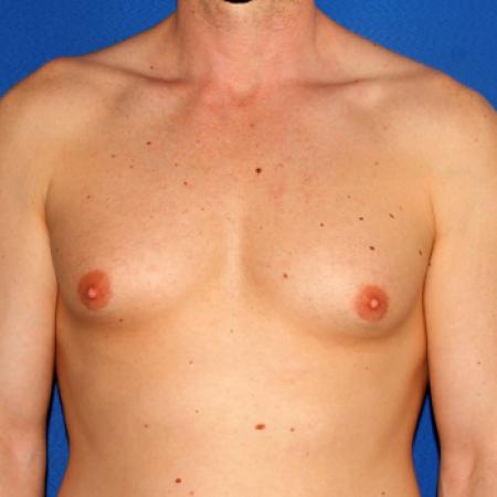 Before image 1 Case #109226 - Gynecomasta Correction