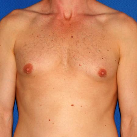 After image 1 Case #109226 - Gynecomasta Correction