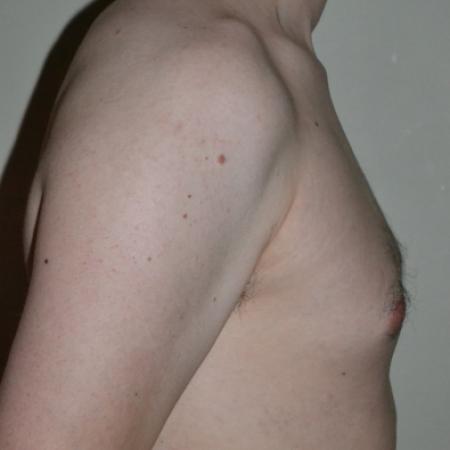 Before image 3 Case #109976 - Gynecomastia  Surgery