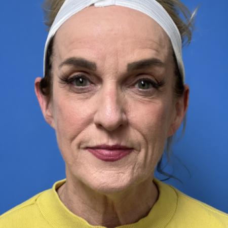 Before image 1 Case #111311 - Facelift/Lower Blepharoplasty