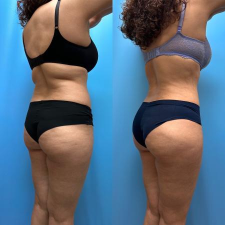 After image 4 Case #110351 - Tummy Tuck, Lipo, Brazilian Butt Lift, Renuvion