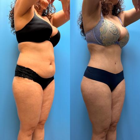 After image 2 Case #110351 - Tummy Tuck, Lipo, Brazilian Butt Lift, Renuvion
