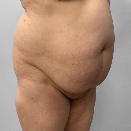 Before Case #111851 - Tummy Tuck, Lipo, & BBL