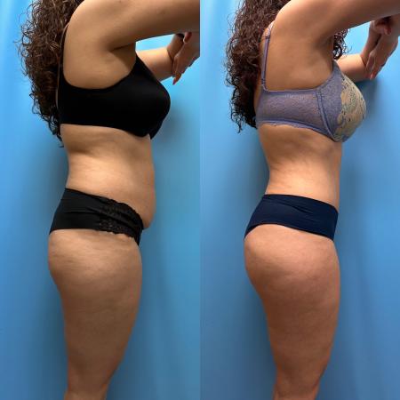 After image 3 Case #110351 - Tummy Tuck, Lipo, Brazilian Butt Lift, Renuvion