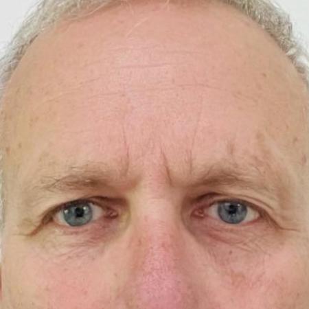 Before image 1 Case #114196 - Upper Eyelid Lift