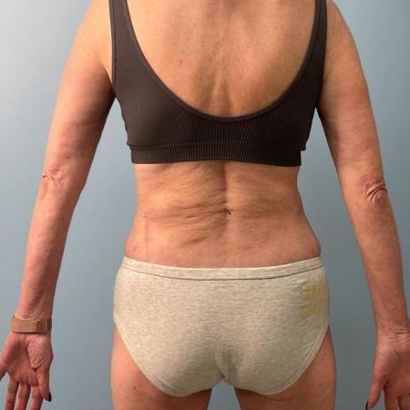 After image 2 Case #112266 - Liposuction