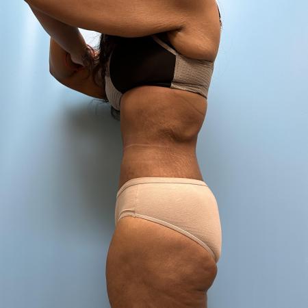 After image 3 Case #112356 - Body Lift/360 Tummy Tuck