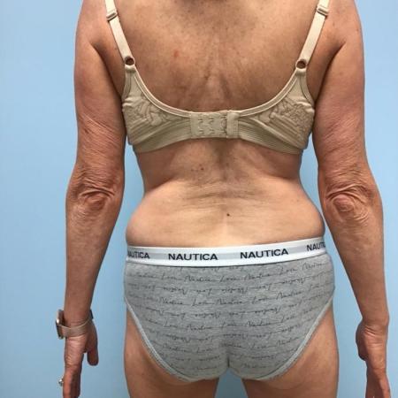 Before image 2 Case #112266 - Liposuction