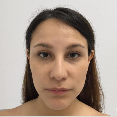 Before image 1 Case #115116 - Rhinoplasty surgery 