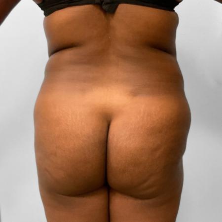 Before image 4 Case #115711 - BBL, Tummy Tuck, & Liposuction