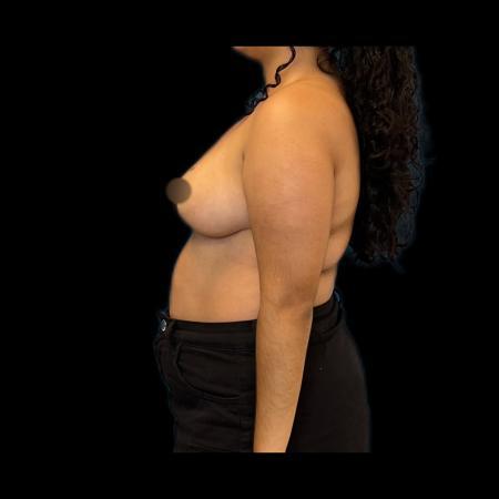 After image 5 Case #115991 - Reduction Mamoplasty 