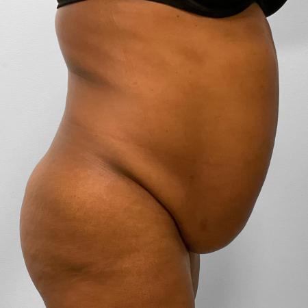 Before image 3 Case #115711 - BBL, Tummy Tuck, & Liposuction