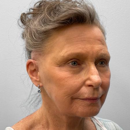 After Case #116881 - Facelift