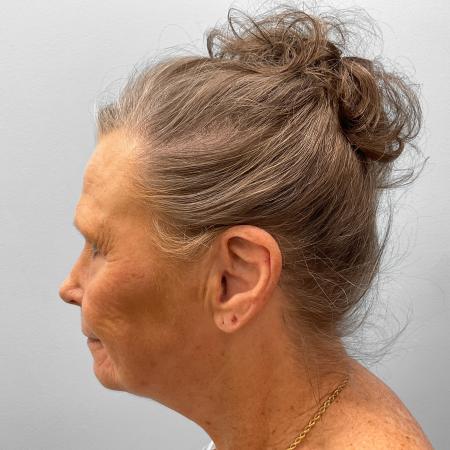 Before Case #116881 - Facelift