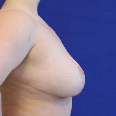 After image 3 Case #116806 - 22 year-old patient | Breast Reduction