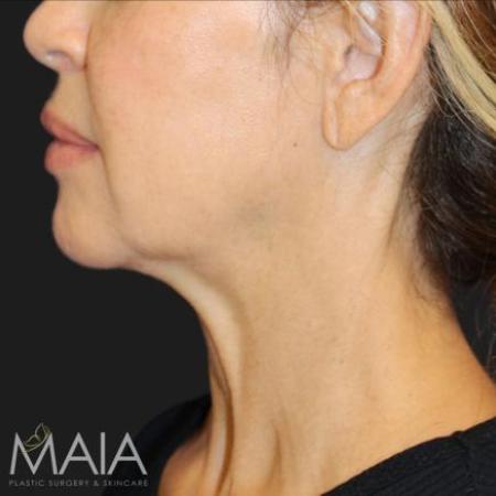 Before image 4 Case #116241 - 55 year old patient | Facial Rejuvenation