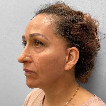 After image 2 Case #116876 - Facelift & Laser Resurfacing