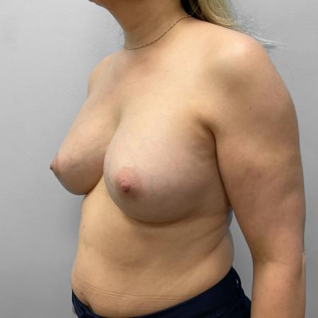 Before image 2 Case #116861 - Breast Augmentation