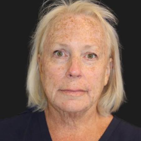 Before image 3 Case #116246 - 63 year old patient | Facial Rejuvenation