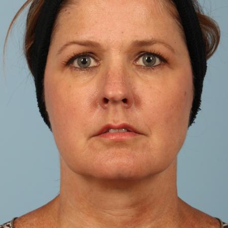 Before image 1 Case #116611 - Facelift and Eyelid Rejuvenation