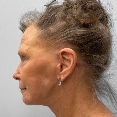 After Case #116881 - Facelift