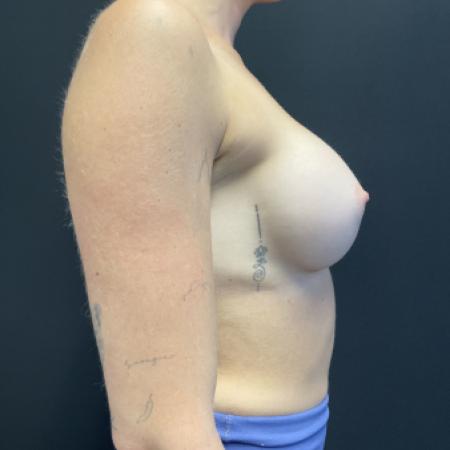 After image 3 Case #116176 - Breast Augmentation