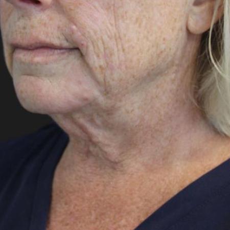 Before image 2 Case #116246 - 63 year old patient | Facial Rejuvenation