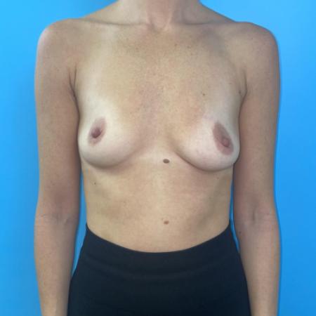 Before image 1 Case #116836 - Breast implants with internal lift