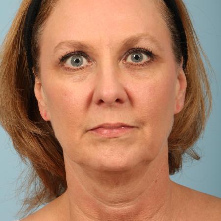 Before image 1 Case #116591 - Facelift, Necklift, TCA Peel