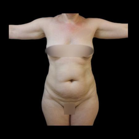 Before image 1 Case #116076 - R.A.F.T LipoAbdominoplasty and LipoEsculture 