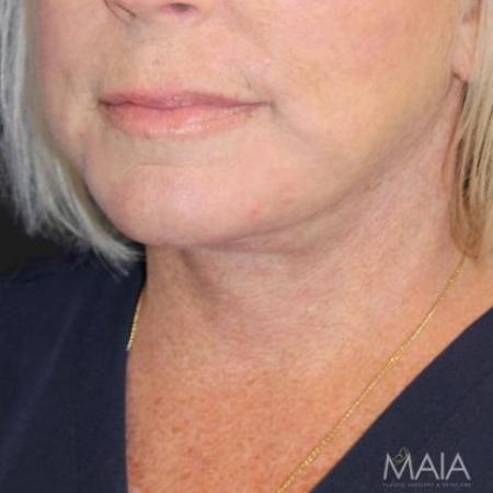 After image 2 Case #116246 - 63 year old patient | Facial Rejuvenation