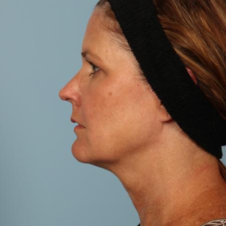 Before image 3 Case #116501 - Facelift and Eyelid Contouring